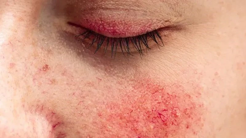 Uống rượu vang quá nhiều sẽ có nguy cơ cao mắc bệnh Rosacea